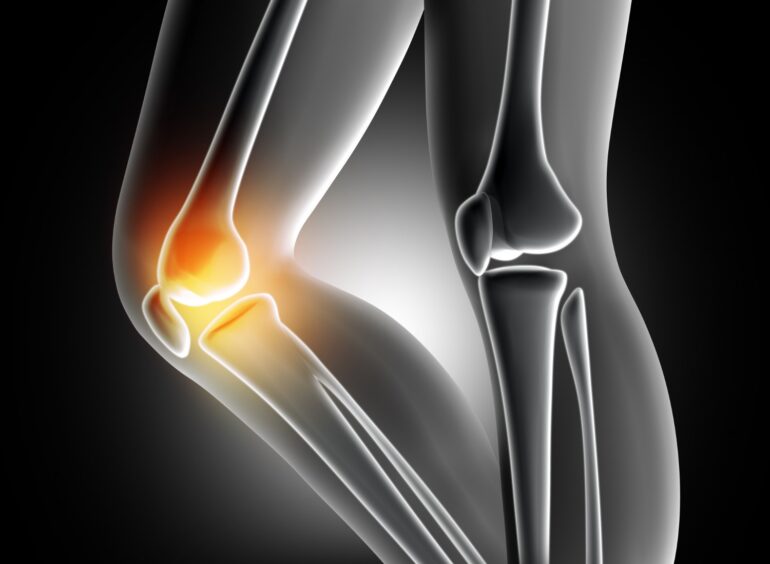 Ρομποτική Αρθροπλαστική Γόνατος: H σύγχρονη απάντηση στην αρθρίτιδα