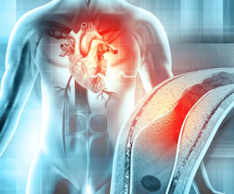 Στεφανιαίες βλάβες: Νέα αναίμακτη μέθοδος εκτίμησης της βαρύτητάς τους