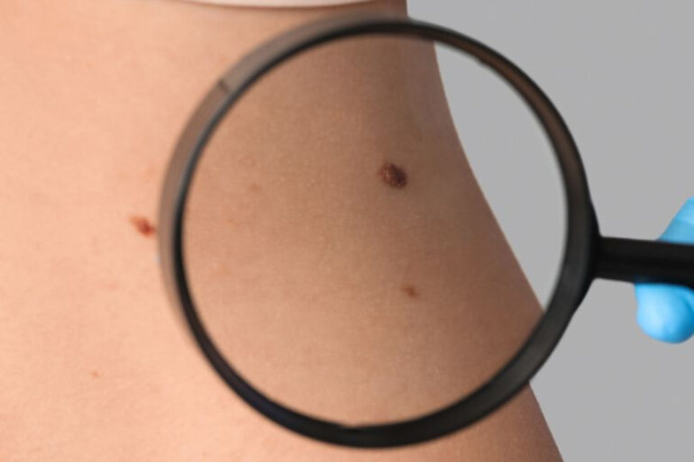 Σπίλοι: Πότε να μας ανησυχήσει μια ελιά στο δέρμα;